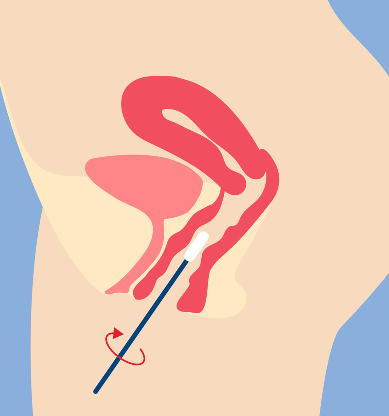 Illustration eines menschlichen Körpers im Querschnitt mit einem Stab, der in die Vagina eingeführt wird.